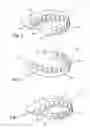 Fig. 02 - Flexible denture and method to make same