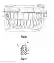 Fig. 06 - Dental template and method of visually demonstrating an overlay for a dental patient and setting the horizontal plane with an overlay
