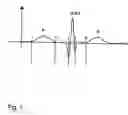 Fig. 02 - System and method for analysing the p-wave of an ecg-signal
