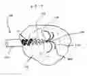 Fig. 01 - Bipolar radio frequency ablation device with retractable insulator