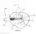 Fig. 02 - Bipolar radio frequency ablation device with retractable insulator