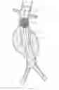 Fig. 03 - Catheter-based fastener implantation apparatus and methods