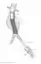 Fig. 12 - Catheter-based fastener implantation apparatus and methods