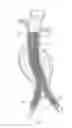 Fig. 21 - Catheter-based fastener implantation apparatus and methods