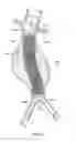 Fig. 29 - Catheter-based fastener implantation apparatus and methods