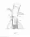 Fig. 37 - Catheter-based fastener implantation apparatus and methods