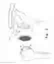Fig. 04 - Joint resurfacing orthopaedic implant and associated method