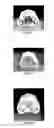 Fig. 02 - Two-phase invisible orthodontics