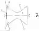 Fig. 04 - Insertable piggable plug system