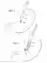 Fig. 02 - Method and apparatus for endoscopically performing gastric reduction surgery