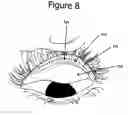Fig. 08 - Eye treatment