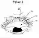 Fig. 09 - Eye treatment