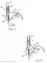 Fig. 07 - Apparatus and method for securing the stomach to the diaphragm for use, for example, in treating hiatal hernias and gastroesophageal reflux disease