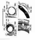 Fig. 18 - Medical device with coating that promotes endothelial cell adherence and differentiation