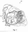 Fig. 02 - Occlusion device