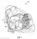 Fig. 02 - Occlusion apparatus