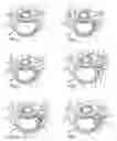 Fig. 02 - System and devices for the repair of a vertebral disc defect