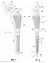 Fig. 04 - Intrinsic stability in a total hip stem