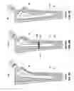 Fig. 07 - Intrinsic stability in a total hip stem
