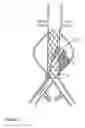 Fig. 08 - Devices and methods for treatment of vascular aneurysms