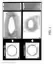 Fig. 02 - Composition and Method for Treatment and Prevention of Restenosis