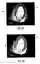 Fig. 09 - Ultrasonic imaging system and method for simulataneous display of blood flow and perfusion parameters