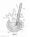Fig. 07 - Systems and methods for providing cavities in interior body regions