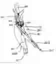 Fig. 01 - Endograft