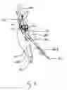 Fig. 07 - Endograft