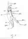 Fig. 08 - Endograft