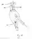 Fig. 11 - Endograft