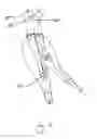 Fig. 12 - Endograft