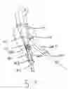 Fig. 14 - Endograft