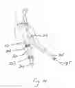 Fig. 15 - Endograft