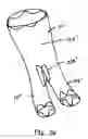 Fig. 21 - Endograft