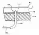Fig. 01 - Devices and methods for use in performing transmyocardial coronary bypass