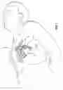 Fig. 02 - Devices and methods for use in performing transmyocardial coronary bypass