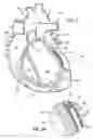 Fig. 03 - Devices and methods for use in performing transmyocardial coronary bypass
