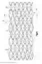 Fig. 02 - Stent with pockets for containing a therapeutic agent