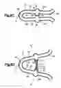 Fig. 05 - Stent with web-inducing nodes for increased surface area