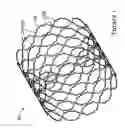 Fig. 02 - Method of manufacturing a stent