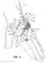 Fig. 05 - PIV dressing assembly