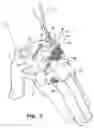 Fig. 06 - PIV dressing assembly
