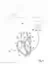 Fig. 09 - Using implanted sensors for feedback control of implanted medical devices
