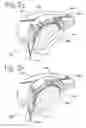 Fig. 07 - Silicon-based transducer for use in hearing instruments and listening devices