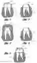 Fig. 02 - Method for creating a temporary dental crown