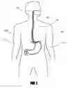 Fig. 02 - Method and apparatus for adjusting body lumens