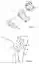 Fig. 02 - Joint prosthesis and method of implanting same