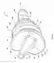 Fig. 06 - Radial-capitellar implant