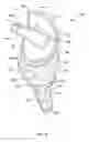 Fig. 07 - Radial-capitellar implant